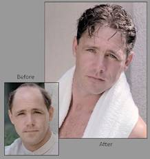Alopecia