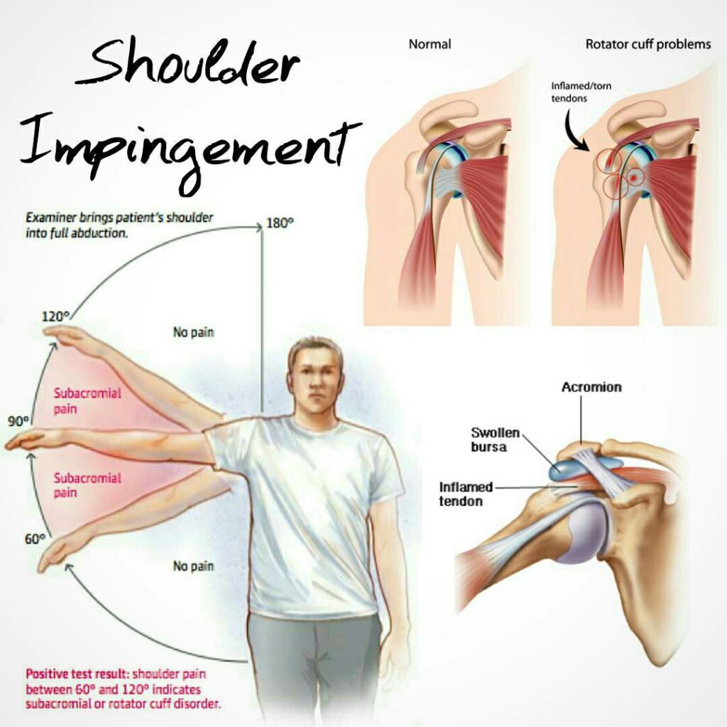 Shoulder Impingement Rotator Cuff Tendinitis Health Happening