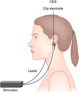 Cranial Electrotherapy Stimulation (CES)<span class="font-95"> – Treats pain, insomnia, fibromyalgia, depression, stress, anxiety, substance abuse </span>