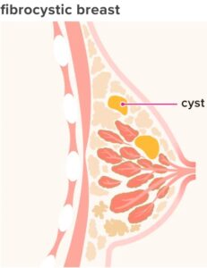 Iodine against cysts