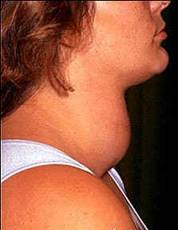 What is a goiter?