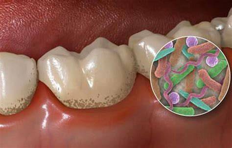 Instructions for using CDS to make an effective mouthwash