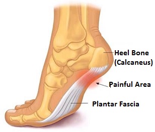 Plantar fasciitis – Pain under the heel