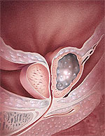 Prostate Cancer (PC)