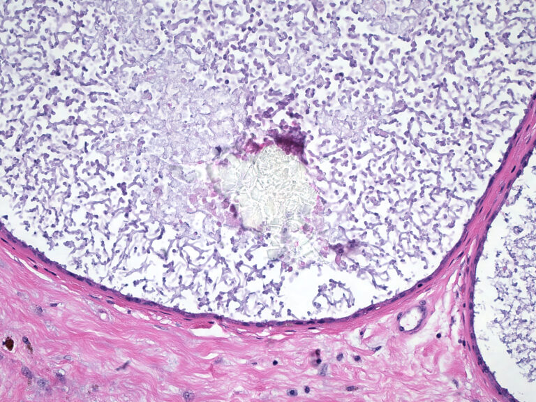 Fibrocystic changes (FCCs) in breasts